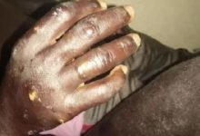 Sénégal: Une “maladie mystérieuse” apparaît à Thiaroye Sur-Mer
