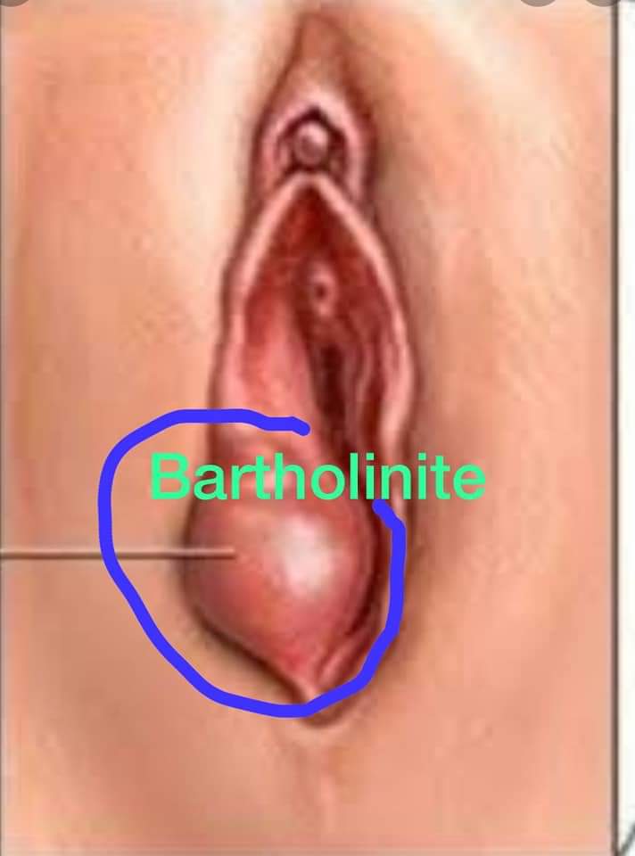 La Bartholinite: une infection génitale assez fréquente