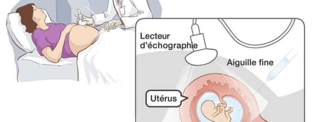 La femme enceinte doit réaliser trois échographies avant l’accouchement, (Pr Charlemagne Ouédraogo)